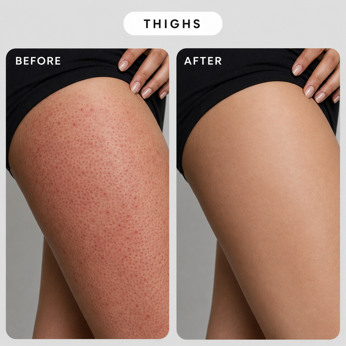 Thigh before and after: red follicular bumps on the left, smoother skin on the right