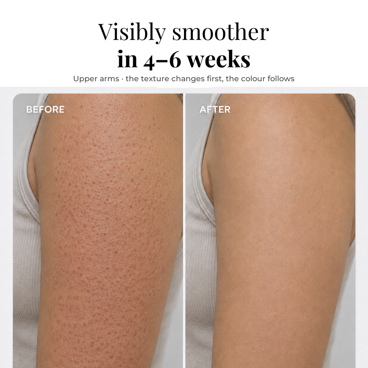Visibly smoother in 4 to 6 weeks: upper arm before and after